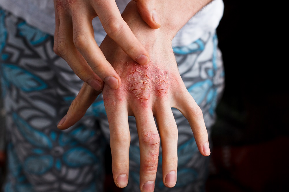 Psoriasis : avez-vous vraiment TOUT essayé ?