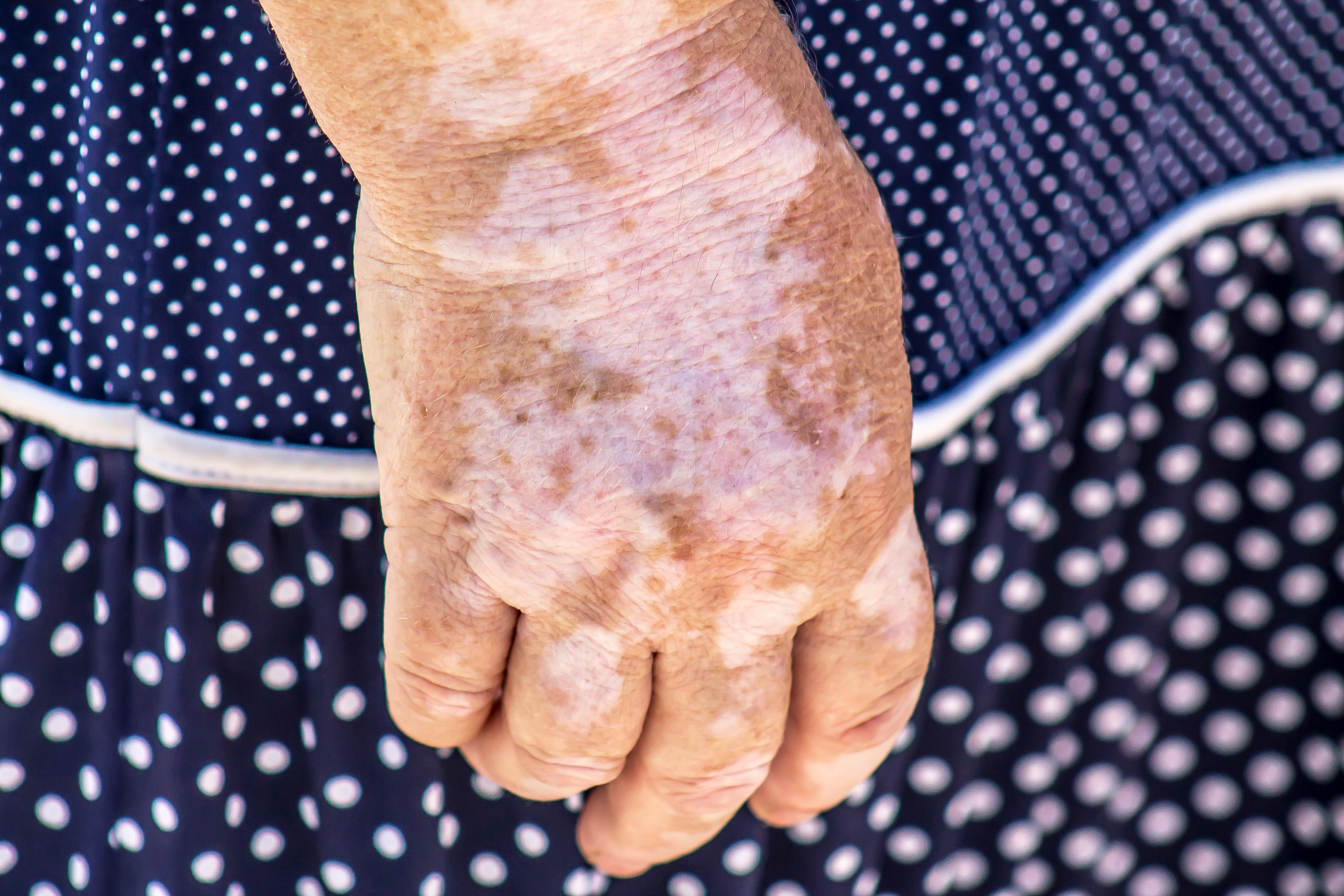 Vitiligo : offrez-vous une nouvelle beauté