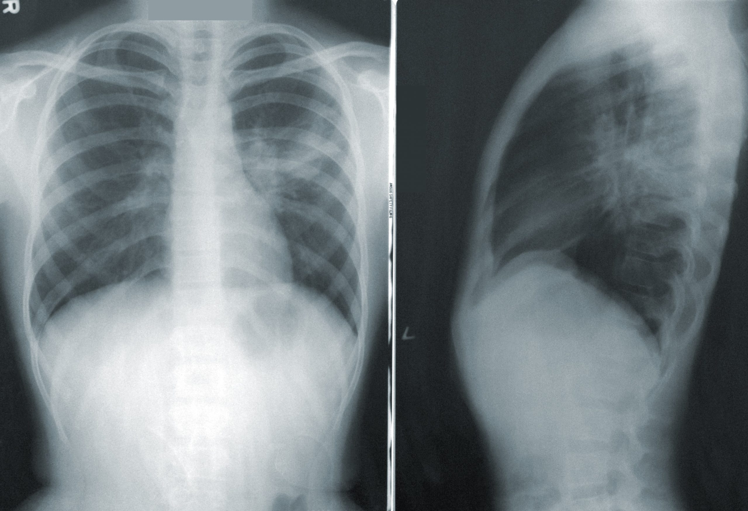 Fibrose pulmonaire (des séquelles fréquentes)