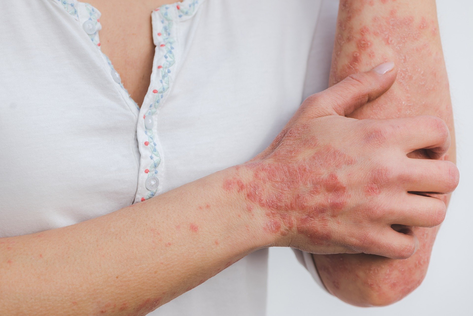 PSORIASIS : ces plaques qui nous gâchent la vie !