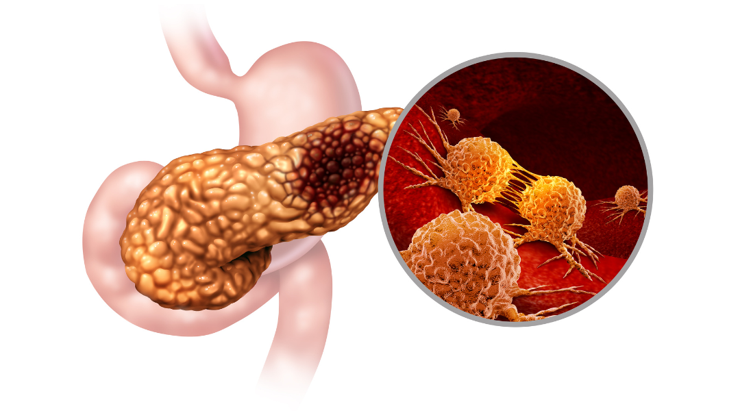 LE CANCER DU PANCRÉAS