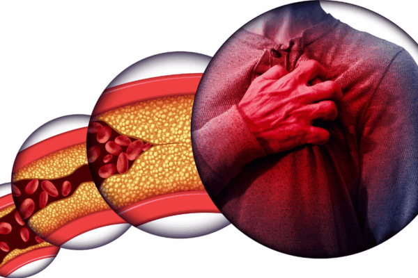 L’athérosclérose