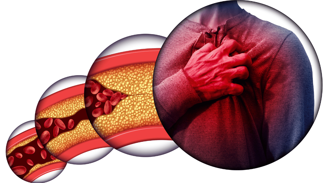 L’athérosclérose